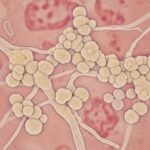 Yeast Infection: A Practical Canadian Guide to Symptoms, Treatment, and Prevention