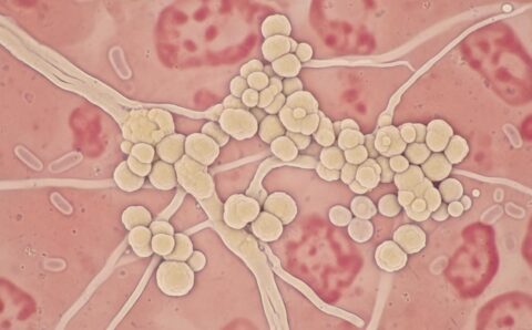 Yeast Infection: A Practical Canadian Guide to Symptoms, Treatment, and Prevention